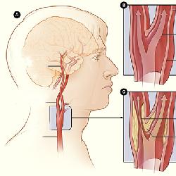Mọi Điều cần biết về tai biến mạch máu não - Đột qụy não