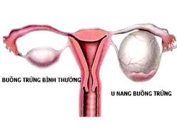 Đẩy bay u nang buồng trứng ra khỏi cơ thể phụ nữ nên biết!