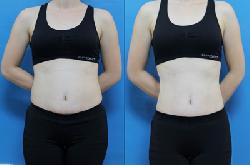 Cách giảm mỡ bụng, giảm cân hiệu quả cho nữ giúp bụng phẳng lỳ nhanh