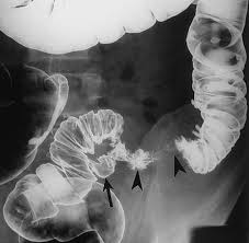Biểu hiện của viêm đại tràng khi chụp X-quang