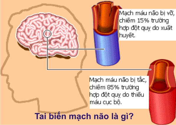 Các dạng đột quỵ não