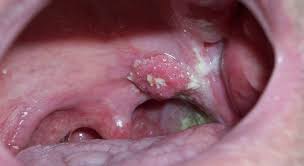 Quan hệ tình dục bằng miệng có thể gây ra ung thư vòm họng