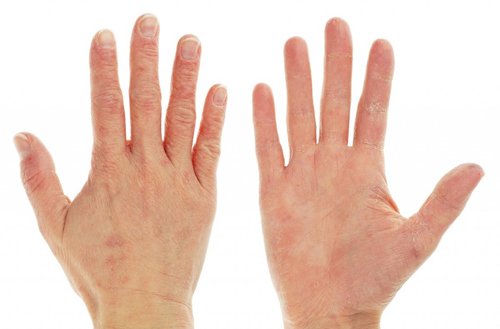 Cách chữa da tay khô nứt nẻ nhờ kem dưỡng da tay trị nẻ Hibikea Muhi 