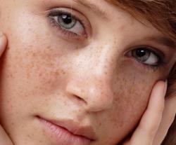 Top 7 cách trị nám da mặt tại nhà Đơn giản và vô cùng hiệu quả