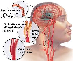 Cảnh báo: bệnh Đột quỵ não, tai biến mạch máu não gây tử vong hàng Đầu hiện nay