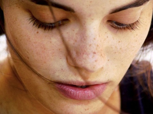 Cách trị nám da mặt tự nhiên an toàn và hiệu quả bạn nên biết