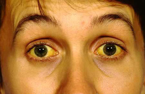 Mắt chuyển màu vàng có thể là triệu chứng của bệnh viêm gan B