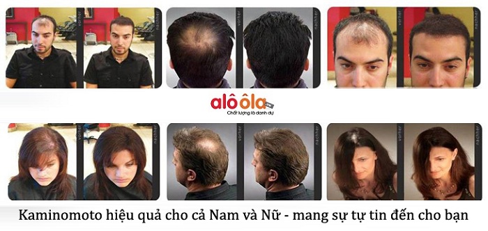 4 Công Dụng Của Thuốc Mọc Tóc Kaminomoto Hair Growth Accelerator