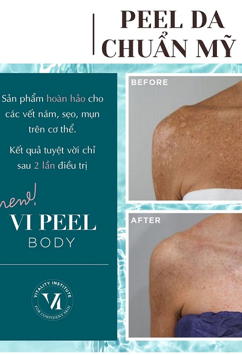 VI Peel Body – Thay da hóa học dành riêng cho làn da cơ thể