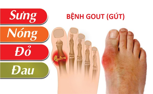 Bệnh Gút (Gout)