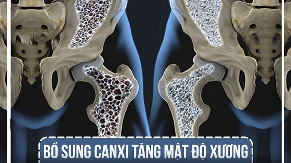 Canxi ảnh hưởng đến mật độ xương và bệnh loãng xương